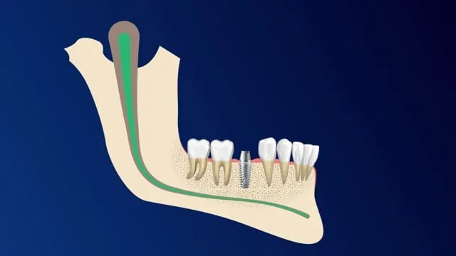 Thumbnail for Dental Implant Surgery Informed Consent Video