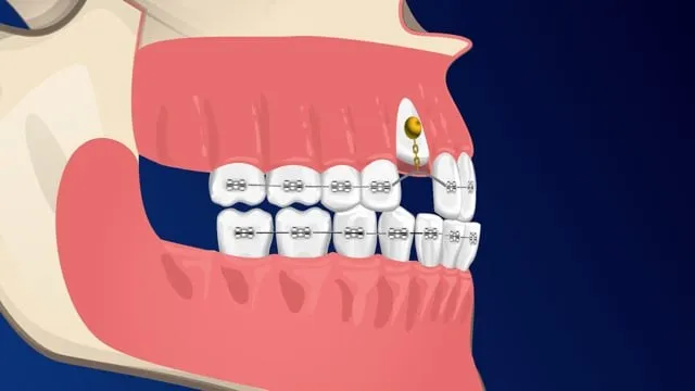 Thumbnail for Exposure and Bond Surgery Informed Consent Video