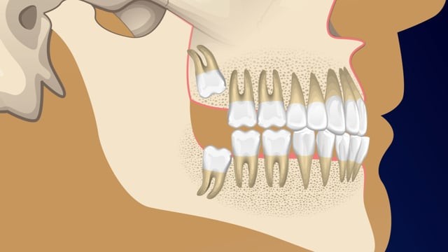 Thumbnail for Wisdom Tooth Surgery Informed Consent Video
